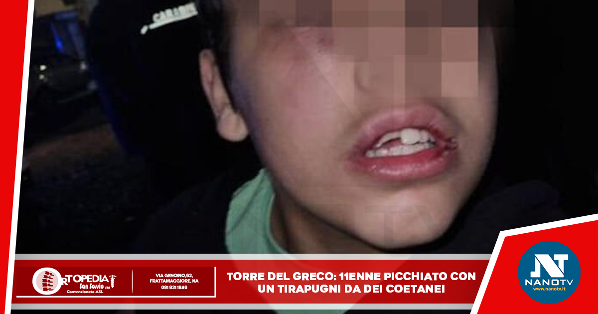 11enne picchiato con un tirapugni da coetanei